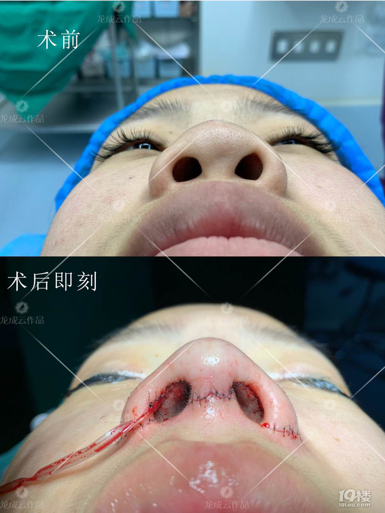 怎么样才能让鼻子变好看呢？