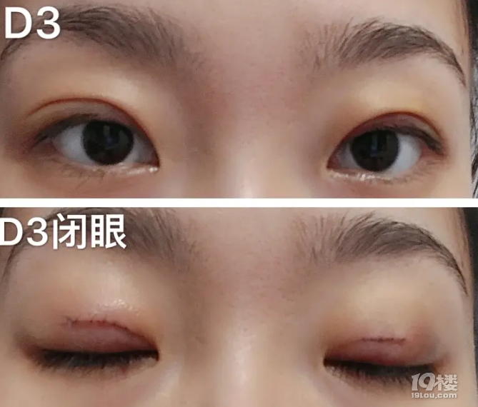 张晓刚医生微创双眼皮手术案例分享