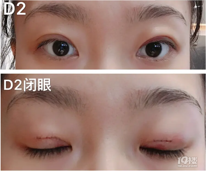 张晓刚医生微创双眼皮手术案例分享