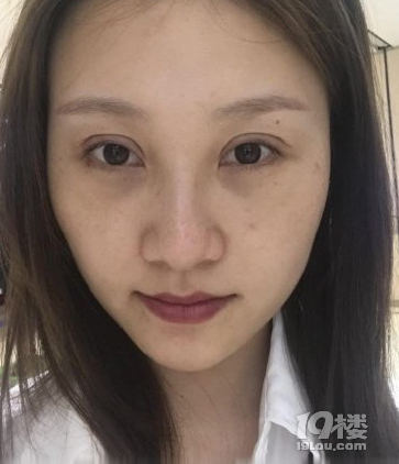 张学艳院长的不开刀去眼袋真实案例分享