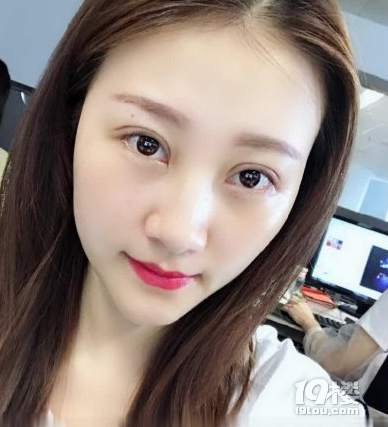 张学艳院长的不开刀去眼袋真实案例分享