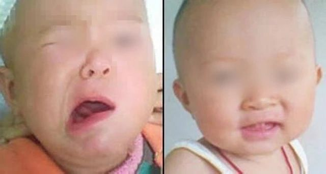 浙江妈妈突然发现2岁儿子半张脸都歪了！这病近期高发