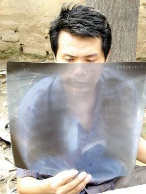 為了證明自己有塵肺病,我選擇了“開胸驗肺”