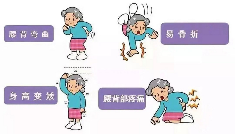 58岁阿姨挺不起腰板,竟是全身筋骨“蛀空”?女性朋友们要注意