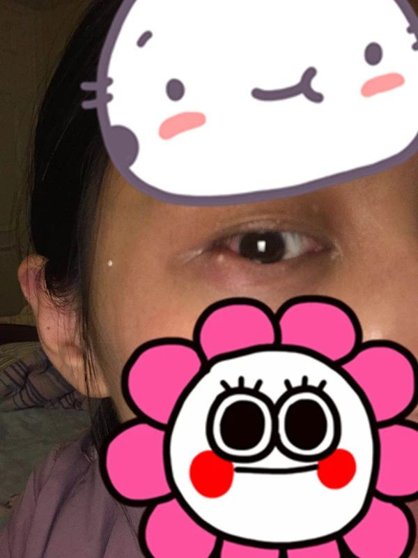 長個麥粒腫而已,怎么最后還要開刀呢?