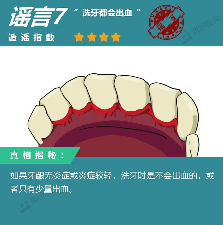 洗牙會不會傷牙?洗牙的8大傳言,據說99%的中國人都信了