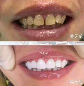 ?幽贻p人的美白牙齒騙局,別再上當了