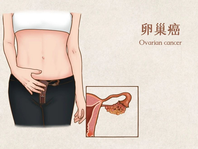 這類病,有很強(qiáng)的家族遺傳史,專家建議盡早防治