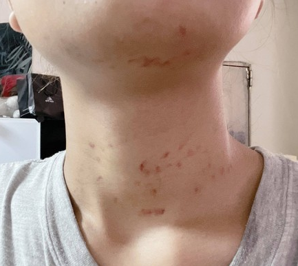 草莓印照片 脖子图片
