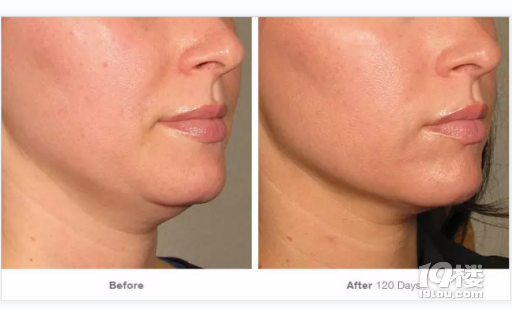 自从做完超声刀美容脸起皮,卡粉,想知道做完超声刀后如何补水!