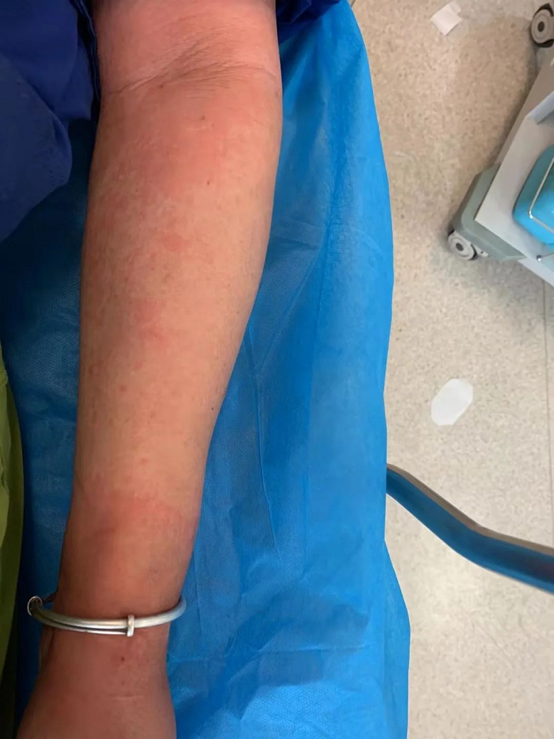 杭州俩阿姨被蜂蜇伤送急诊医生提醒被蜇伤后千万不能这么做