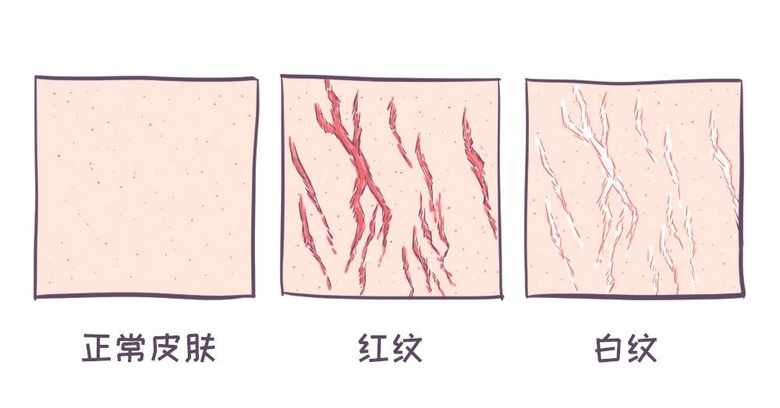 身上的这种纹，没怀孕也会有，4招可改善
