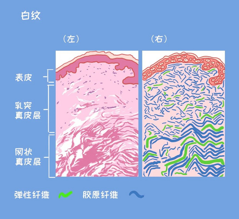 身上的这种纹，没怀孕也会有，4招可改善