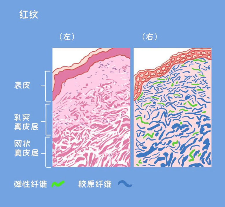 身上的这种纹，没怀孕也会有，4招可改善