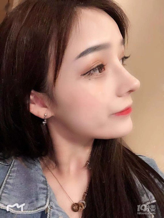 隆鼻手术多久恢复自然,隆鼻手术后要注意些什么!