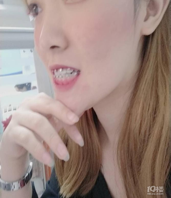浙大紫金港校区附近牙齿矫正多少钱？