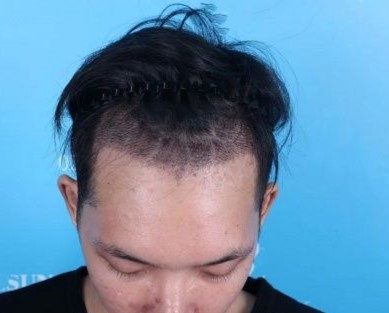秃头少年问头发少种头发可以吗、植发的毛囊从哪里来？