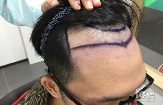秃头少年问头发少种头发可以吗、植发的毛囊从哪里来？