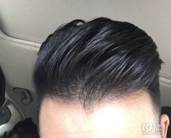 秃头少年问头发少种头发可以吗、植发的毛囊从哪里来？