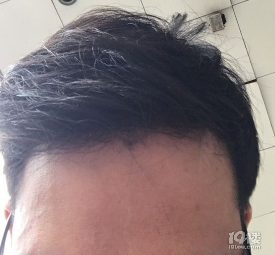 秃头少年问头发少种头发可以吗、植发的毛囊从哪里来？