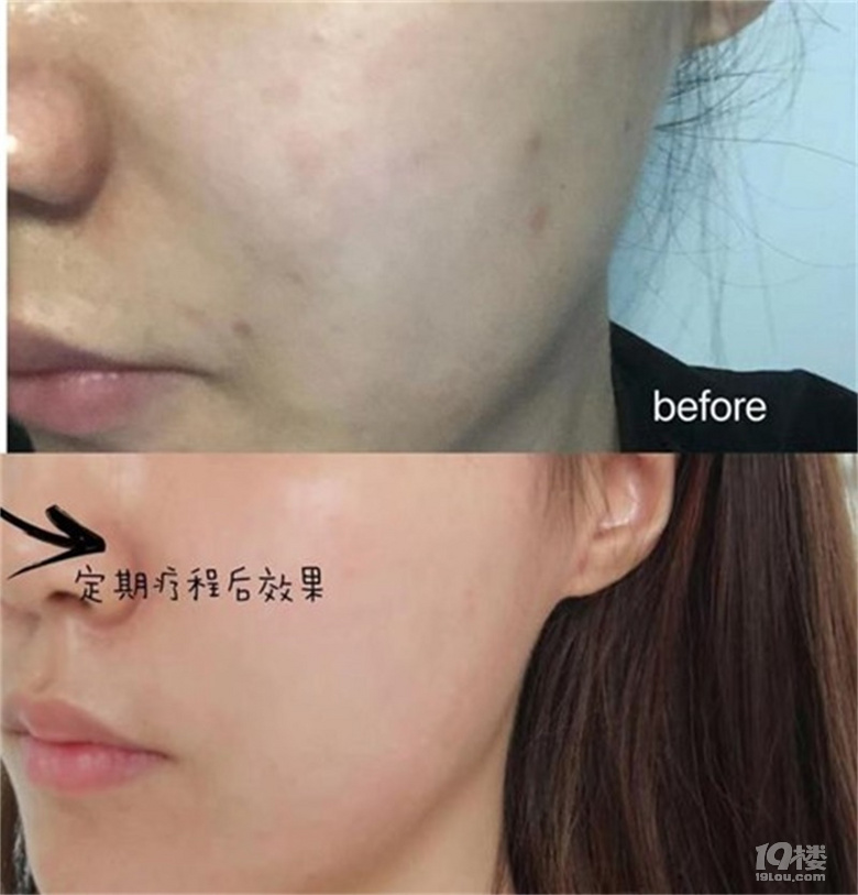 打完水光针后脸过敏怎么处理、打完水光后三天内如何护理？