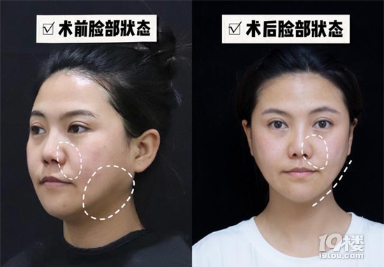 欧洲之星是什么美容项目：欧洲之星有什么效果