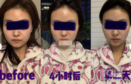 面部埋线提升多久消肿，面部埋线多久恢复