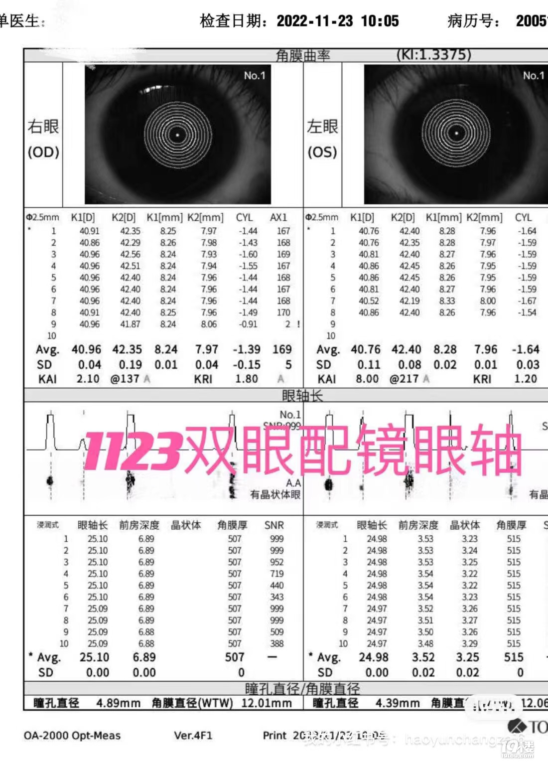 三个月降轴0.25 负增长75度 近视不可逆？