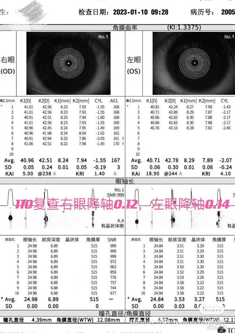 三个月降轴0.25 负增长75度 近视不可逆？