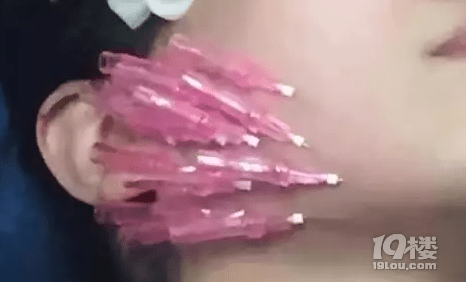 大v线雕的危害, 做完线雕脸上有凹陷怎么办闺蜜吓傻了~