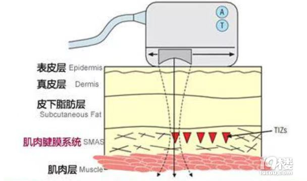 盘点下超 声刀适合多大年龄做，超 声刀美容后注意事项~