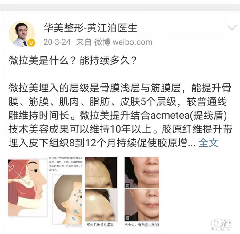 聊聊微拉美面部提升为什么贵、微拉美面部提升多少钱~