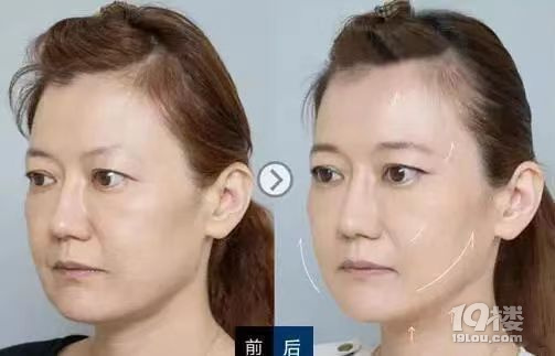 聊聊微拉美面部提升为什么贵、微拉美面部提升多少钱~
