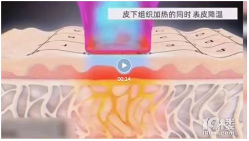 做完超声炮要肿多久、做超声炮几天出效果~