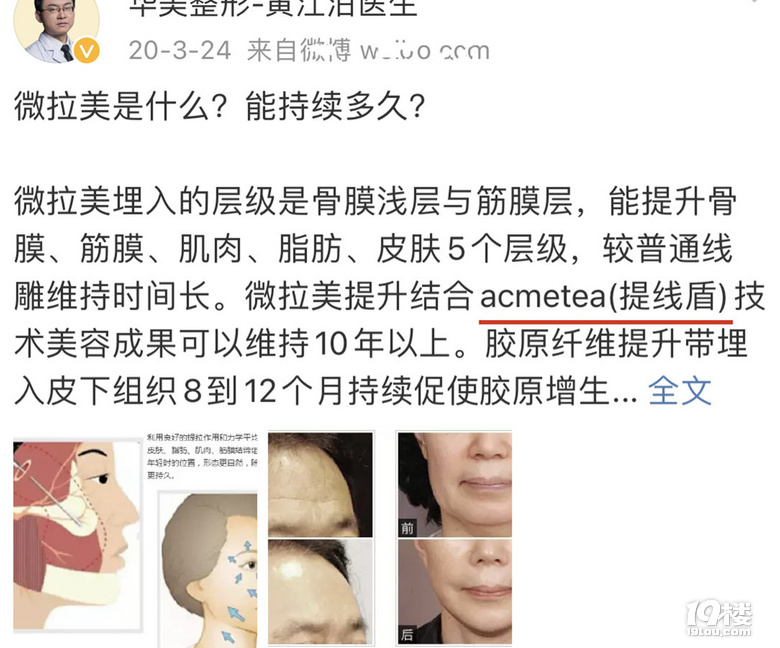 微拉美提升能保持几年、微拉美手术过程图~