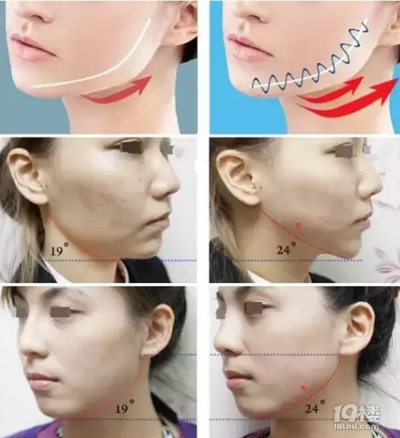 微拉美提升能保持几年、微拉美手术过程图~