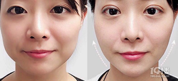 微拉美提升能保持几年、微拉美手术过程图~