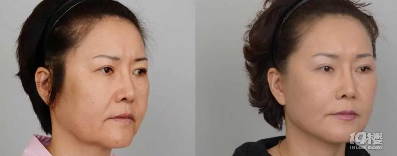 筋膜悬吊面部提升术怎么做、保持多久、竟说大实话~