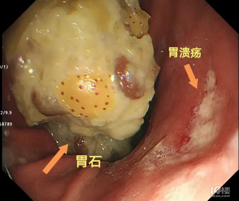 近期大量上市,有人食用后入院!緊急提醒
