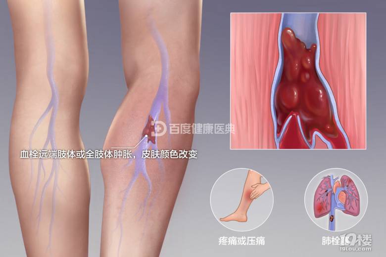 ?靜脈曲張合并血栓?警惕“靜脈炎”的致命風險