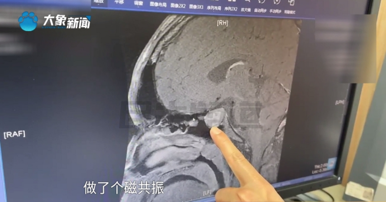 16歲男孩身高瘋長(zhǎng)到199cm!檢查后發(fā)現(xiàn)體內(nèi)長(zhǎng)了個(gè)……