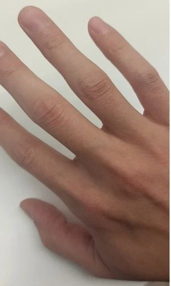 伸手阻擋老婆扔來的枕頭,我手指成了“倒直角”形狀
