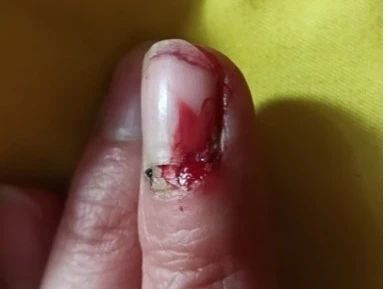 伸手阻擋老婆扔來的枕頭,我手指成了“倒直角”形狀