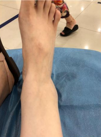 從樓梯滑飛后,我收獲了一只骨頭上有洞洞的腳踝