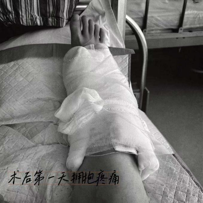 從樓梯滑飛后,我收獲了一只骨頭上有洞洞的腳踝