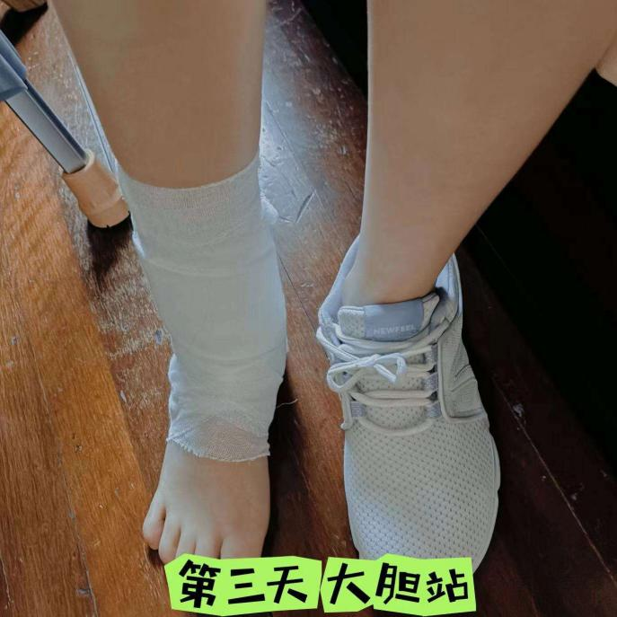 從樓梯滑飛后,我收獲了一只骨頭上有洞洞的腳踝