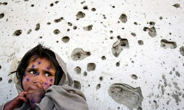 7岁的莫伯巴脸上涂满了药膏,她患上一种被称为利什曼病的皮肤疾病