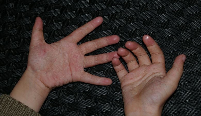 川崎病手指图片