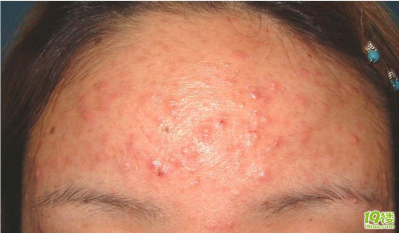 大家帮帮忙,什么卸妆油防粉刺呢?