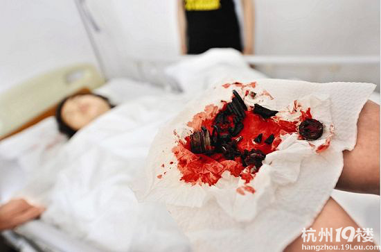 升降椅爆炸 一女子被击穿下体 大量碎片嵌入身体……(图)
